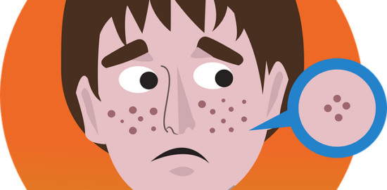 Boj s akné: Informative článek s užitečnými radami