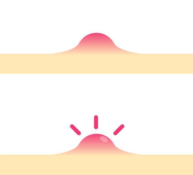 Jak se zbavit akné – Informative