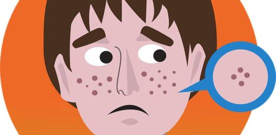 Akné: Informative Článek