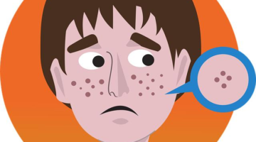 Akné a jeho účinná léčba pomocí moderních metod